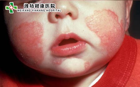 濰坊皮膚病醫(yī)院：預(yù)防嬰兒濕疹的措施